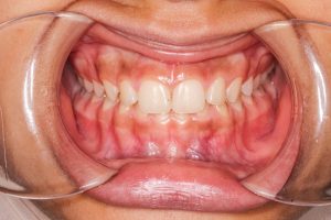 神保町野本歯科医院で前歯が大きいと悩む方へ：原因と治療法を徹底解説について解説