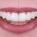 神保町野本歯科医院で前歯が大きいと悩む方へ：原因と治療法を徹底解説について解説