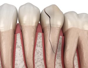 神保町野本歯科医院で神経のない歯（失活歯）が痛い原因と治療法について解説