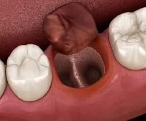 神保町野本歯科医院で、40代以降の親知らずの抜歯リスクについて解説