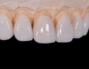 神保町野本歯科医院で前歯が大きいと悩む方へ：原因と治療法を徹底解説について解説