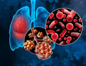 神保町野本歯科医院で、若年層の誤嚥性肺炎について解説