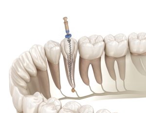 神保町野本歯科医院で歯ぐきが「ぶよぶよ」する！一部だけ腫れる原因について解説