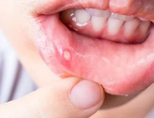 神保町野本歯科医院でお酒を飲むと歯や歯ぐきがズキズキ痛む原因は？当日・翌日の痛みのメカニズムと対処法について解説