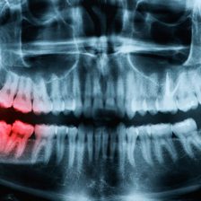 神保町野本歯科医院で、40代以降の親知らずの抜歯リスクについて解説