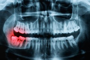 神保町野本歯科医院で、40代以降の親知らずの抜歯リスクについて解説