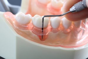 神保町野本歯科医院で黒い歯石は要注意？白い歯石との違い、放置するリスクと専門的な対処法について解説