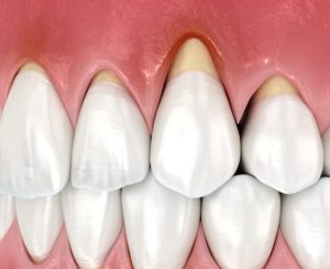 神保町野本歯科医院で、電動歯ブラシで歯周病が悪化する！？電動歯ブラシが「向いている人・向いていない人」について解説