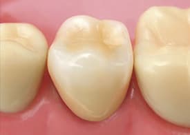 神保町の歯医者、神保町野本歯科医院で、被せ物をした歯が臭い原因について解説