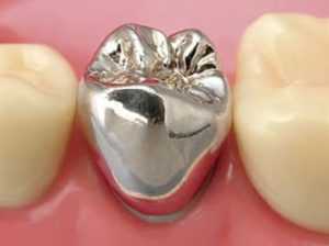 神保町の歯医者、神保町野本歯科医院で、被せ物をした歯が臭い原因について解説