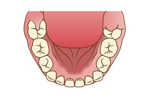 神保町の歯医者、神保町野本歯科医院で、奥歯の歯茎がめくれる原因について解説