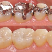 神保町野本歯科医院で銀歯を白い歯に変えるデメリットとは？意外なリスクと後悔しないための選択肢について解説