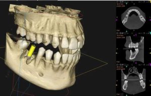 神保町野本歯科医院で、20代で重度の歯周病…、侵襲性歯周炎について解説