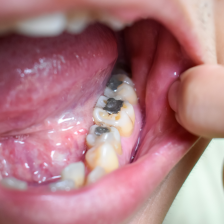 神保町野本歯科医院で銀歯とアマルガム（水銀）は別物！ 見分け方と対処法について解説