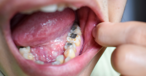 神保町野本歯科医院で銀歯とアマルガム（水銀）は別物！ 見分け方と対処法について解説