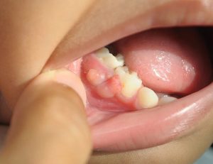 神保町の歯医者、神保町野本歯科医院で、歯ぐきにも口内炎ができる？唇にできる口内炎との違いと、間違いやすい「要注意」な症状について解説