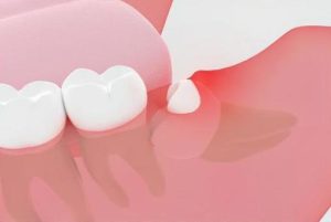 神保町の歯医者、神保町野本歯科医院で、歯ぐきにも口内炎ができる？唇にできる口内炎との違いと、間違いやすい「要注意」な症状について解説