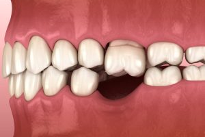 神保町の歯医者、神保町野本歯科医院でおならが多いのは歯が原因?「呑気症(空気嚥下症)」について解説