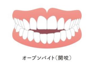神保町の歯医者、神保町野本歯科医院でおならが多いのは歯が原因?「呑気症(空気嚥下症)」について解説