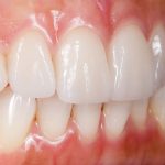 神保町の歯医者、神保町野本歯科医院でダイレクトボンディングとコンポジットレジン、何が違うの？適応症例は？について解説