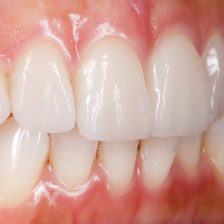 神保町の歯医者、神保町野本歯科医院でダイレクトボンディングとコンポジットレジン、何が違うの？適応症例は？について解説