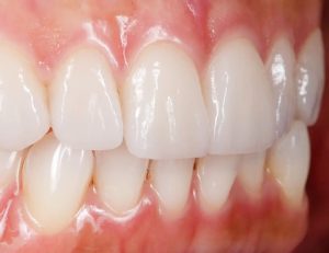 神保町の歯医者、神保町野本歯科医院でダイレクトボンディングとコンポジットレジン、何が違うの？適応症例は？について解説