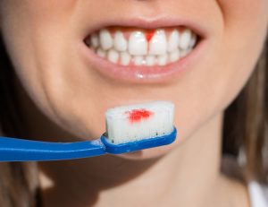 神保町の歯医者、神保町野本歯科医院で、10代の歯ぐきの腫れは「思春期性歯肉炎」かも？成長期のホルモンと歯周病の関係について解説