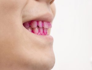 神保町の歯医者、神保町野本歯科医院で、10代の歯ぐきの腫れは「思春期性歯肉炎」かも？成長期のホルモンと歯周病の関係について解説