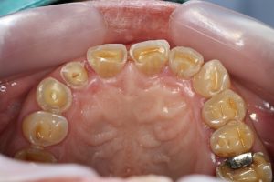 神保町の歯医者、神保町野本歯科医院で、摂食障害の方のための歯科治療：誰にも言えないお口の悩みについて解説