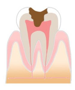 神保町の歯医者、神保町野本歯科医院で「歯がたまに痛い」のはなぜ？「間欠的な痛み」の原因と対策について解説